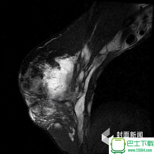 中国整形第一人：经历30多次手术后面临切除乳房